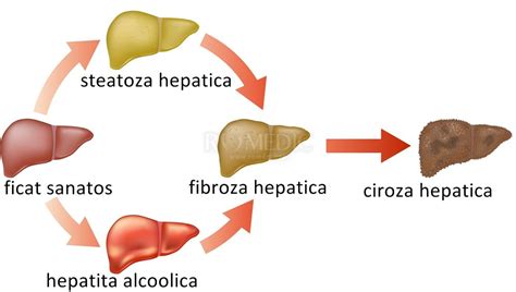 istoric de ciroză hepatică sângerare ascită din varice ale esofagului